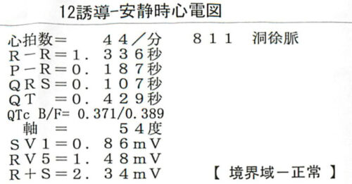 心電図検査の結果